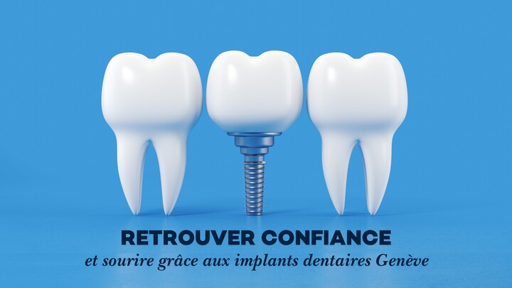 Retrouver confiance et sourire grâce aux implants dentaires Genève
