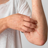 Lupus and the Skin: Understanding Its Impact and Variants\u00a0