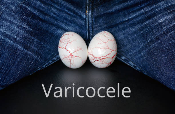 Advanced varicocele surgery in Bhopal