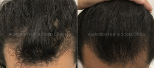 Discover the Best Hair Treatment for Healthy Locks