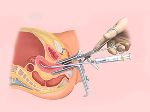 Process of IVF or Test Tube Baby Treatment 