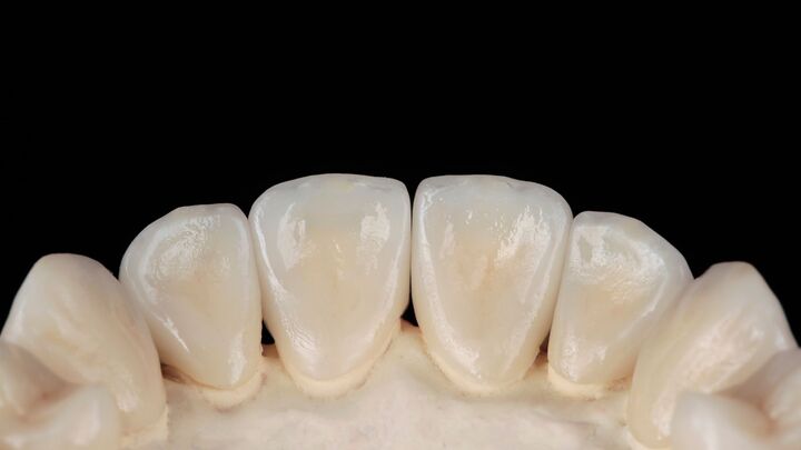 Les facettes dentaires à Genève : une solution esthétique fiable