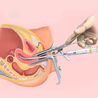 Process of IVF or Test Tube Baby Treatment 