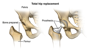 Hip Replacement Surgery: A Patient&#039;s Perspective