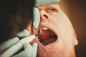 The Role of Cosmetic Dentistry in Restoring Damaged or Worn Teeth