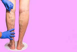 How Does Sclerotherapy Help Eliminate Spider Veins?