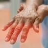 Managing Dysesthesia: Treatment Tools That Help 