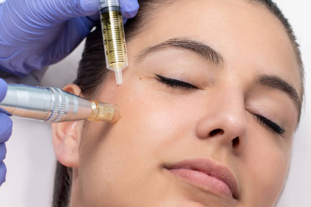 Microneedling for Acne Scars: A Magical Solution to Reclaim Your Skin