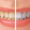 Brighten Your Day with Teeth Whitening in North London
