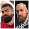 Hair Transplant Results