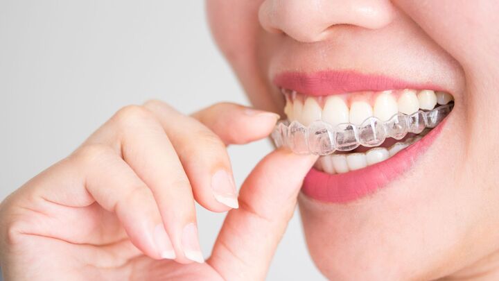 Invisalign in Geneva: Benefits and What to Expect