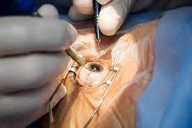 Best Eye Hospital for Phacoemulsification Surgery in Delhi