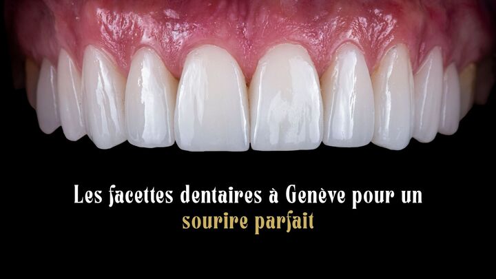 Les facettes dentaires à Genève pour un sourire parfait