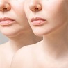 What Are the Benefits of Revision Rhinoplasty?