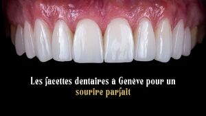 Les facettes dentaires \u00e0 Gen\u00e8ve pour un sourire parfait