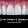 Les facettes dentaires \u00e0 Gen\u00e8ve pour un sourire parfait