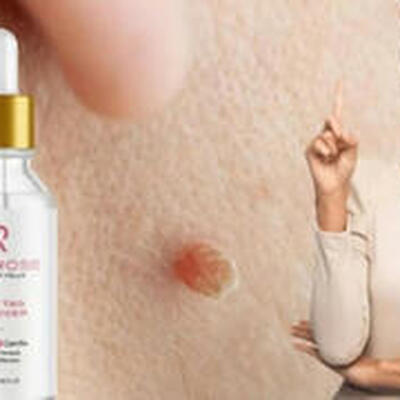 Super Luxe Skin Tag Remover